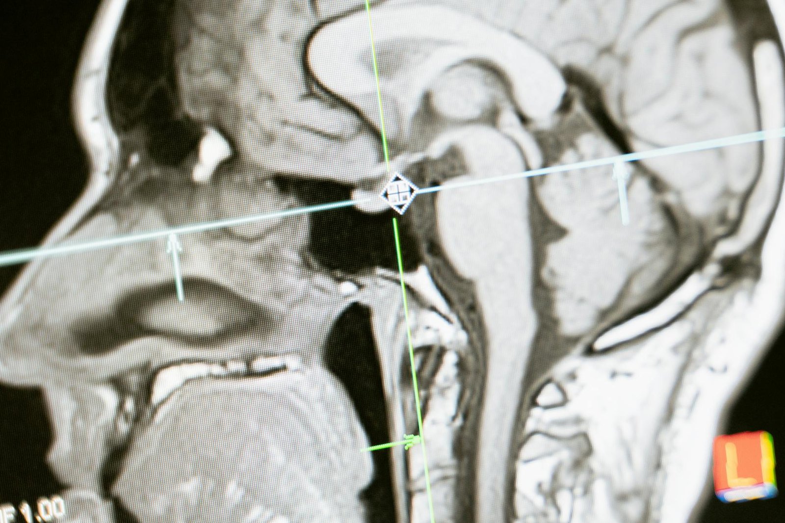 Elevate Your Mental Game: Biohacking Brain Health Essentials