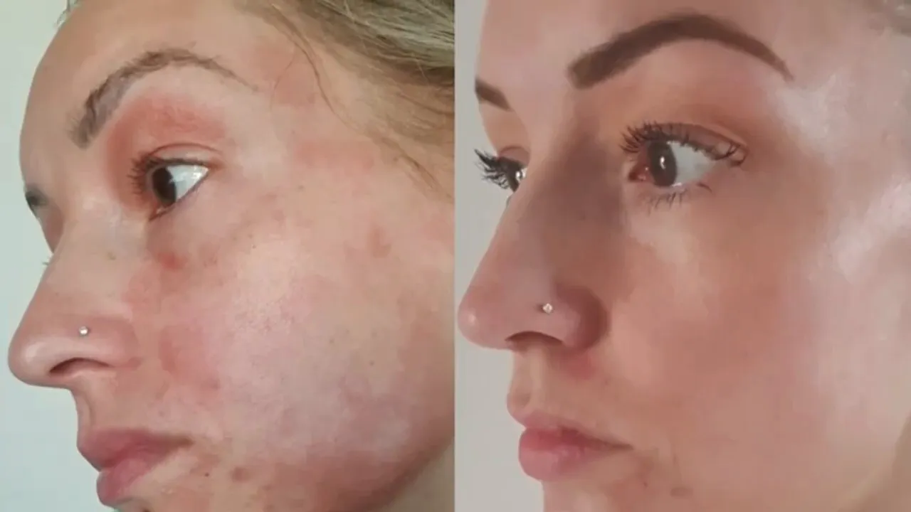 Before and after skin results with stem cell treatment