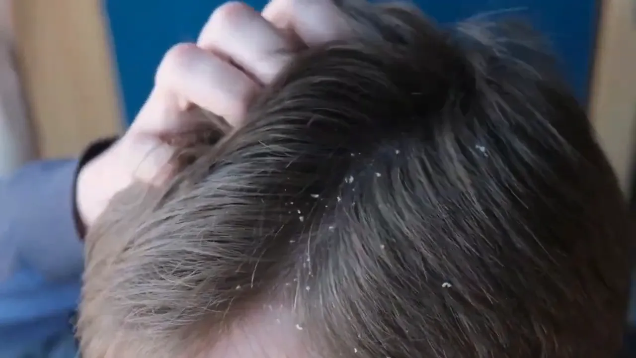 Apple cider vinegar benefits for skin and hair