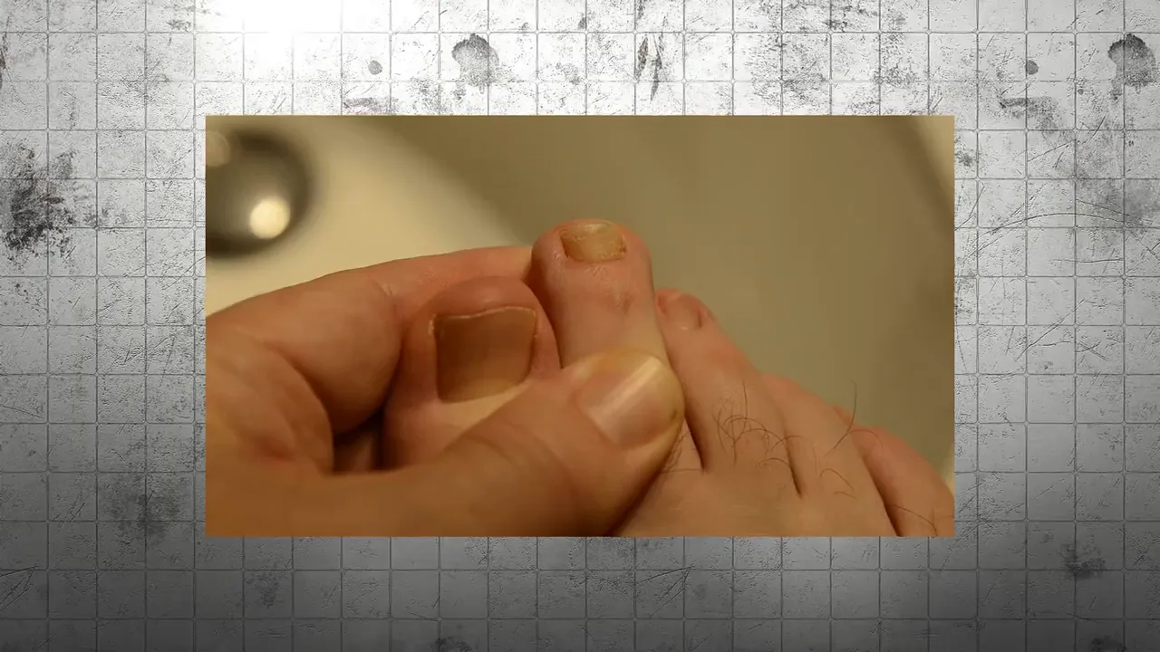Before and after images showing toenail improvement